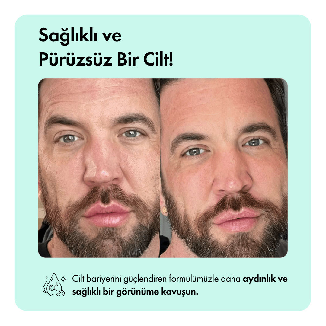 Anti-Acne Temizleme Barı