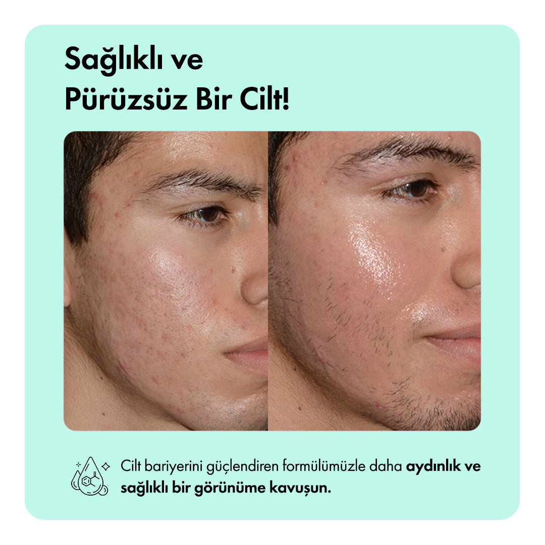 Anti-Acne™ Sivilce Karşıtı Bakım Rutini
