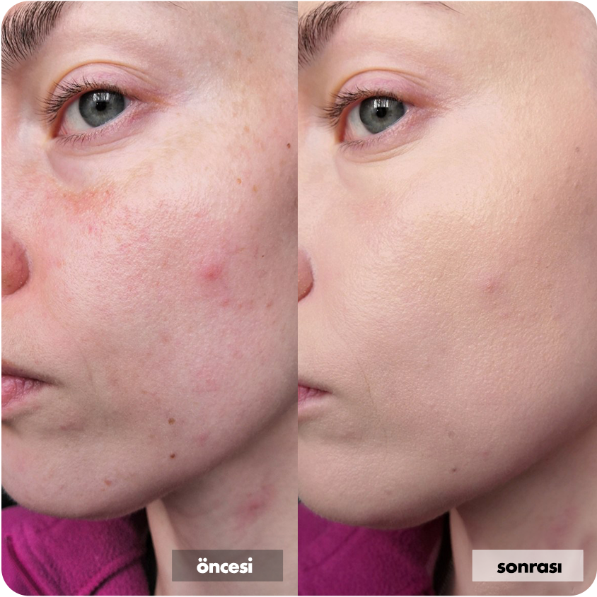 Niacinamide & AHA BHA Cilt Bakım Rutini | Ph Lab – Phlab